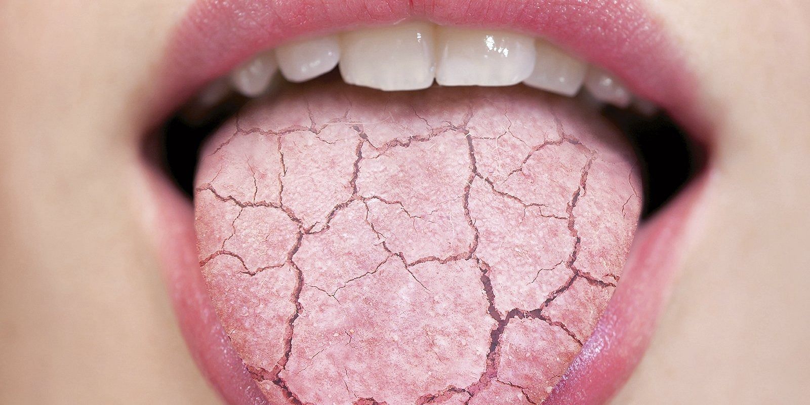 Xerostomia (Image via Getty Images)